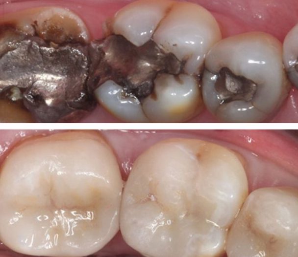 Before and after photos of three amalgam fillings being replaced with tooth-colored composite fillings Before and after photos of three amalgam fillings being replaced with tooth-colored composite fillings