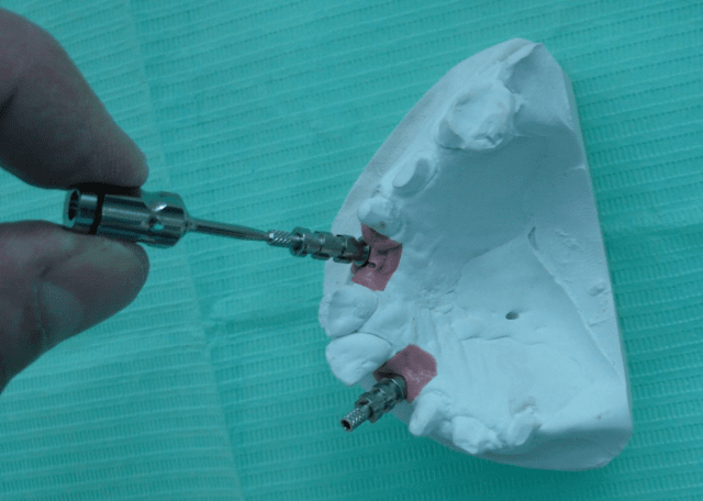 Astra implant impression pickups being removed from a laboratory model