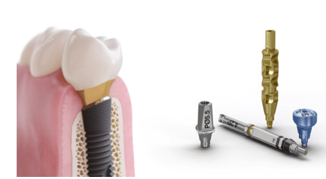 Poster of the Astratech Profile implant design