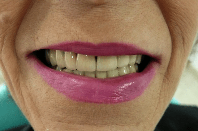 Bad teeth looking great after treatment with Richard!