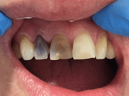 Dark front teeth before composite bonding