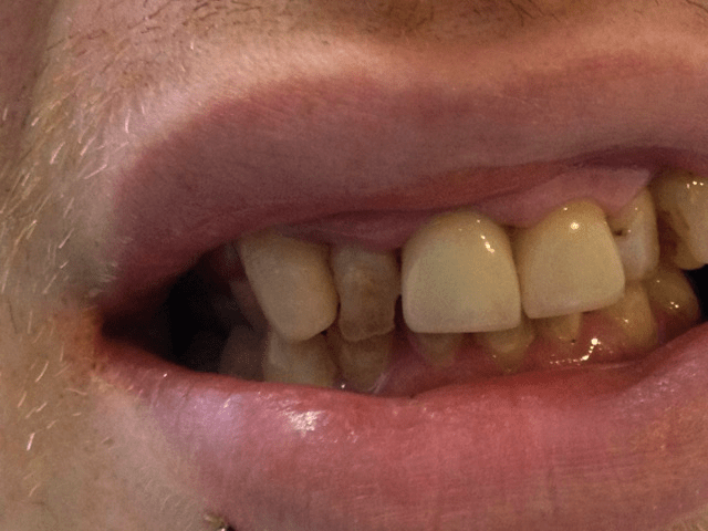 A tooth that looks bad is actually only crooked