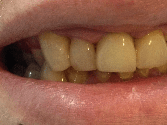 Crooked tooth improved with composite bonding