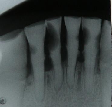 An X-ray of lower front teeth with black  areas indicating tooth decay An X-ray of lower front teeth with black  areas indicating tooth decay