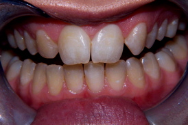 Yellow upper front teeth with the lateral incisors missing