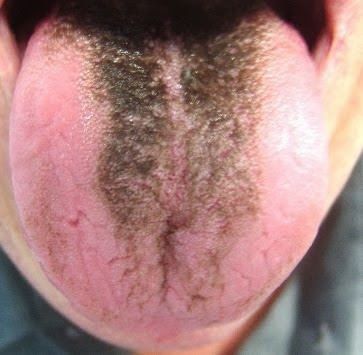 Black hairy tongue Black hairy tongue