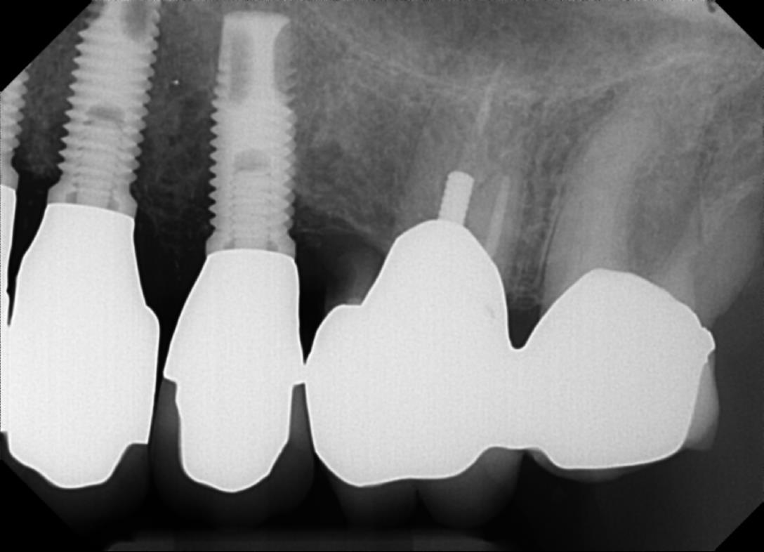 X-Ray of two Branemark dental implants
