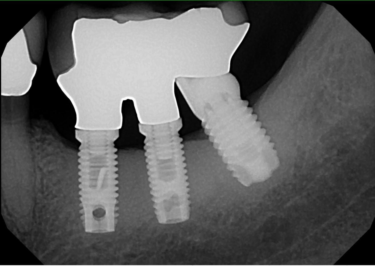 X-ray of 3 Branemark dental implants