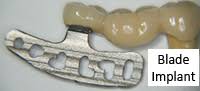 A Blade implant supporting a bridge