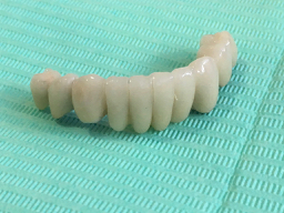 Close-up of a lower dental fixed bridge on a green background