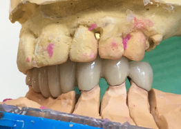 dental bridge cost