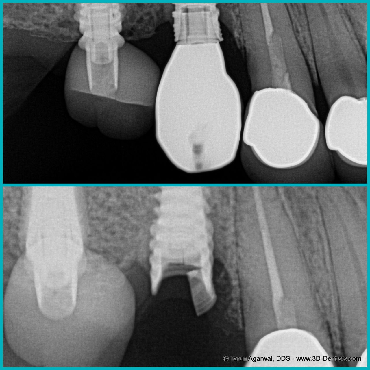 Broken dental implant X ray Broken dental implant X ray