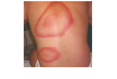 lyme disease skin lesions on a man's back lyme disease skin lesions on a man's back