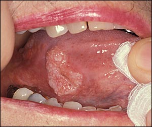 Close-up view of a tongue cancer