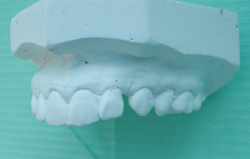 A white plaster dental model of upper teeth resting on a green background