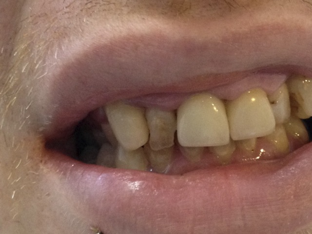 dental composite bonding - before