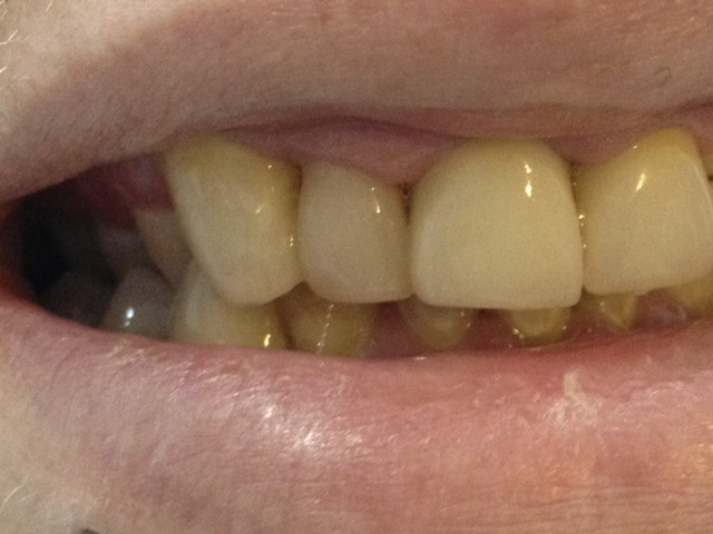 dental composite bonding - after