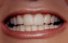 Dental veneers made in California, close up