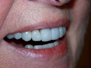 Dental crowns on the front teeth, close up