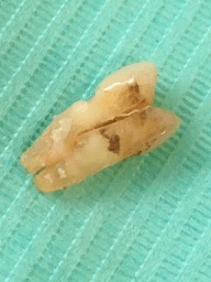 Cracked tooth after extraction, on a green background