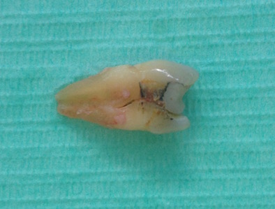 An extracted molar tooth on a green background, with a vertical crack through the root An extracted molar tooth on a green background, with a vertical crack through the root