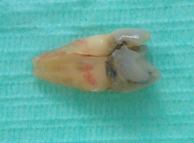 An extracted molar tooth on a green background, with a vertical crack through the root An extracted molar tooth on a green background, with a vertical crack through the root