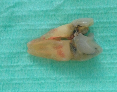 An extracted molar tooth on a green background, with a vertical crack through the root and one side pulled away An extracted molar tooth on a green background, with a vertical crack through the root and one side pulled away