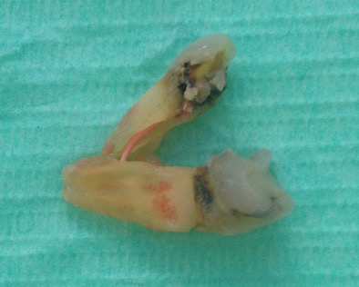 An extracted molar tooth on a green background, with a vertical crack through the root, one side pulled away, and the root filling inside the root visible An extracted molar tooth on a green background, with a vertical crack through the root, one side pulled away, and the root filling inside the root visible