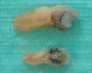 An extracted molar tooth on a green background, with a vertical crack through the root, one side pulled away, and the root filling inside the root visible An extracted molar tooth on a green background, with a vertical crack through the root, one side pulled away, and the root filling inside the root visible