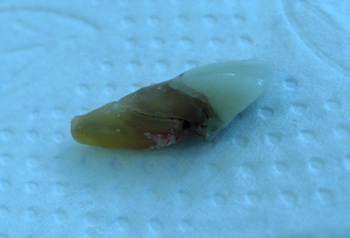 An extracted tooth on a blue background, showing a crack along the root. An extracted tooth on a blue background, showing a crack along the root.