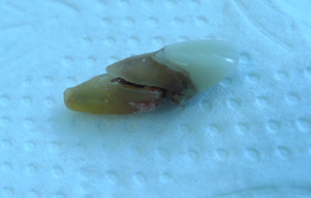 An extracted tooth on a blue background, showing a crack along the root. An extracted tooth on a blue background, showing a crack along the root.