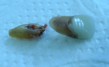 An extracted tooth on a blue background, showing a crack dividing the root in two. An extracted tooth on a blue background, showing a crack dividing the root in two.