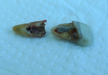 An extracted tooth on a blue background, showing the tooth in two parts. An extracted tooth on a blue background, showing the tooth in two parts.