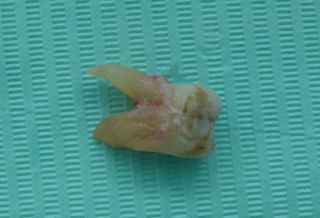 An extracted molar tooth on a blue background An extracted molar tooth on a blue background
