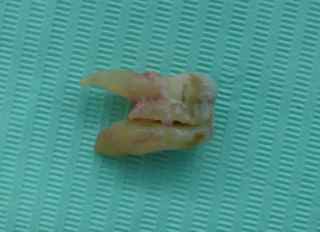 An extracted molar tooth on a blue background, with a crack through the tooth roots An extracted molar tooth on a blue background, with a crack through the tooth roots