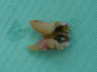 An extracted molar tooth on a blue background, showing a vertical split through the tooth An extracted molar tooth on a blue background, showing a vertical split through the tooth