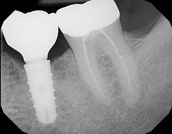 A dental implant next to a root-filled molar tooth A dental implant next to a root-filled molar tooth