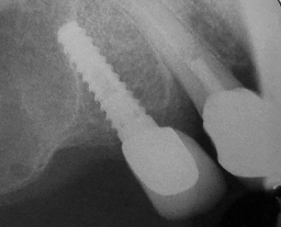 X-ray of a dental implant next to a natural tooth root.