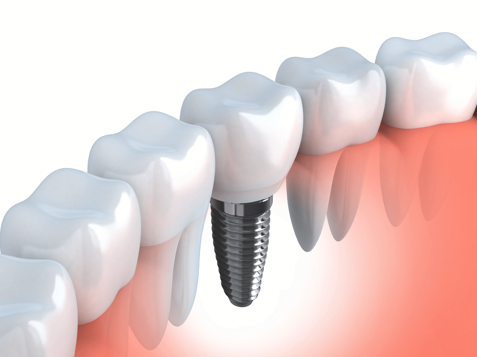 Illustration of a dental implant in the jaw Illustration of a dental implant in the jaw