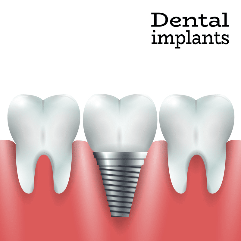 Artwork of a dental implant in the jawbone Artwork of a dental implant in the jawbone