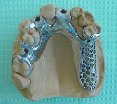 chrome cobalt upper dentures chrome cobalt upper dentures