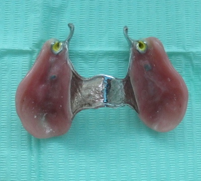 An upper partial denture with metal framework, and precision attachments