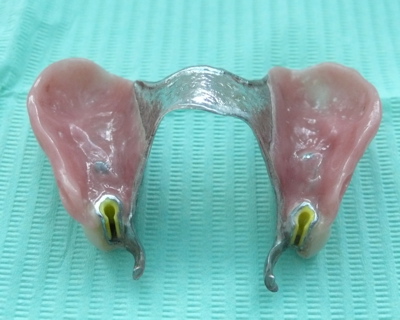 An upper partial denture with metal framework, and precision attachments