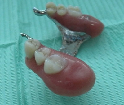 An upper partial denture with metal framework, and precision attachments