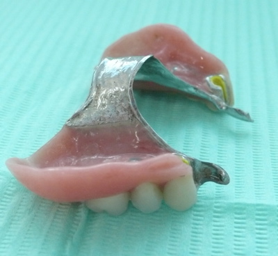 An upper partial denture with metal framework, and precision attachments