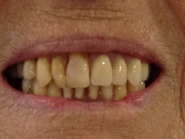 Close up of a woman's teeth after getting new dentures. Close up of a woman's teeth after getting new dentures.