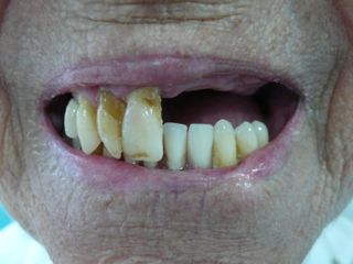 Close up of a womans smile, with half her upper left teeth missing. Close up of a womans smile, with half her upper left teeth missing.