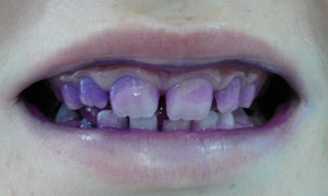 Close-up of a child's teeth after the plaque has been stained with disclosing tablets