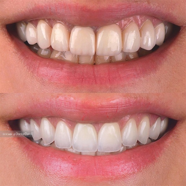 dental veneers before and after