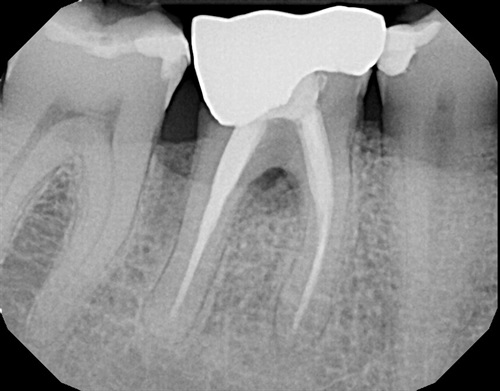 An X-Ray of a lower molar tooth with a root filling, and signs of infection.